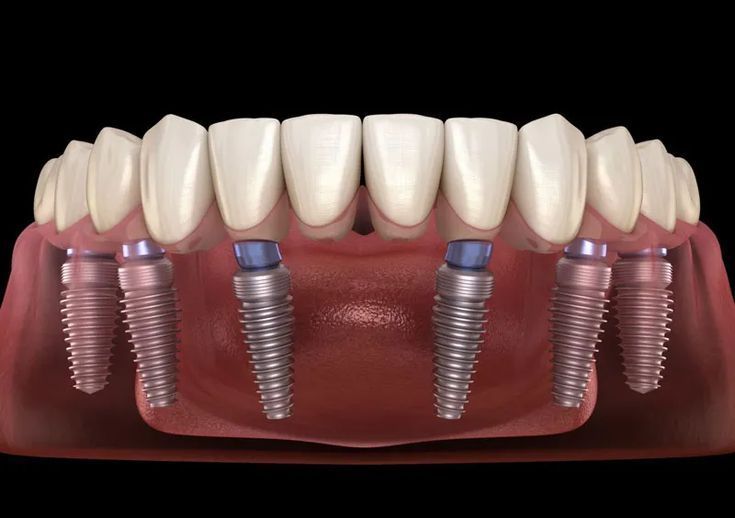 Dental Implants – A Modern Solution for Missing Teeth