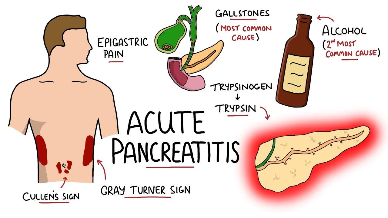 Abdominal Tenderness and Swelling by Acute Pancreatitis: What it is, and How to Book a Consultation Service for Its Treatment Through StrongBody AI