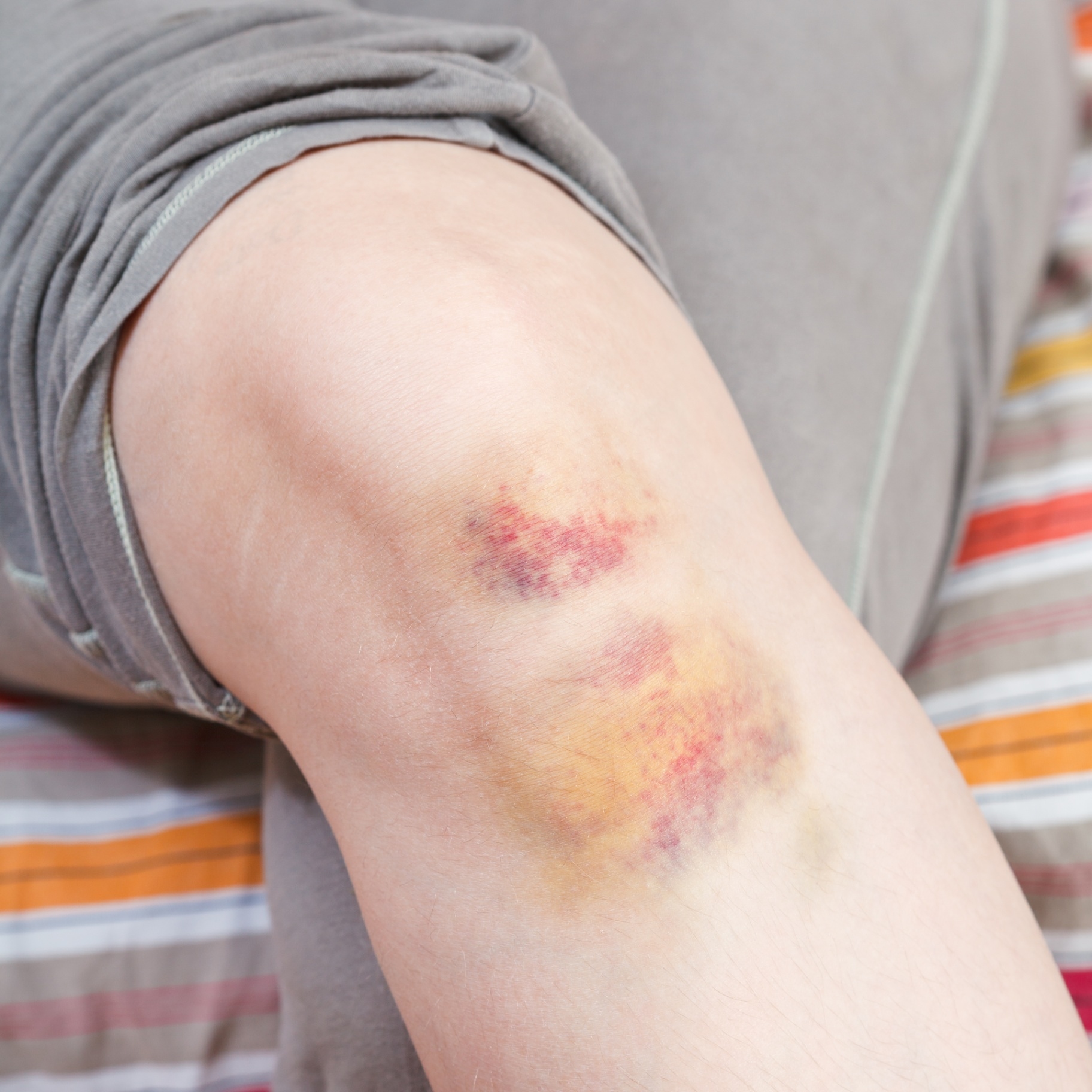 Bruising or Discoloration: What It Means and How to Book a Consultation Service for Its Managements Through StrongBodyAI