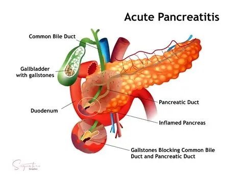 Nausea and Vomiting by Acute Pancreatitis: What it is, and How to Book a Consultation Service for Its Treatment Through StrongBody AI