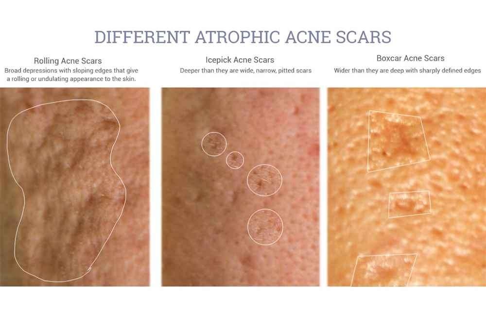 Offline Acne Scar Laser Treatment