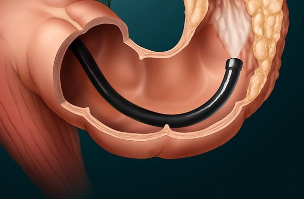 Consultation Service for Chronic Inflammatory Bowel Disease (IBD – Crohn’s & Ulcerative Colitis) 3