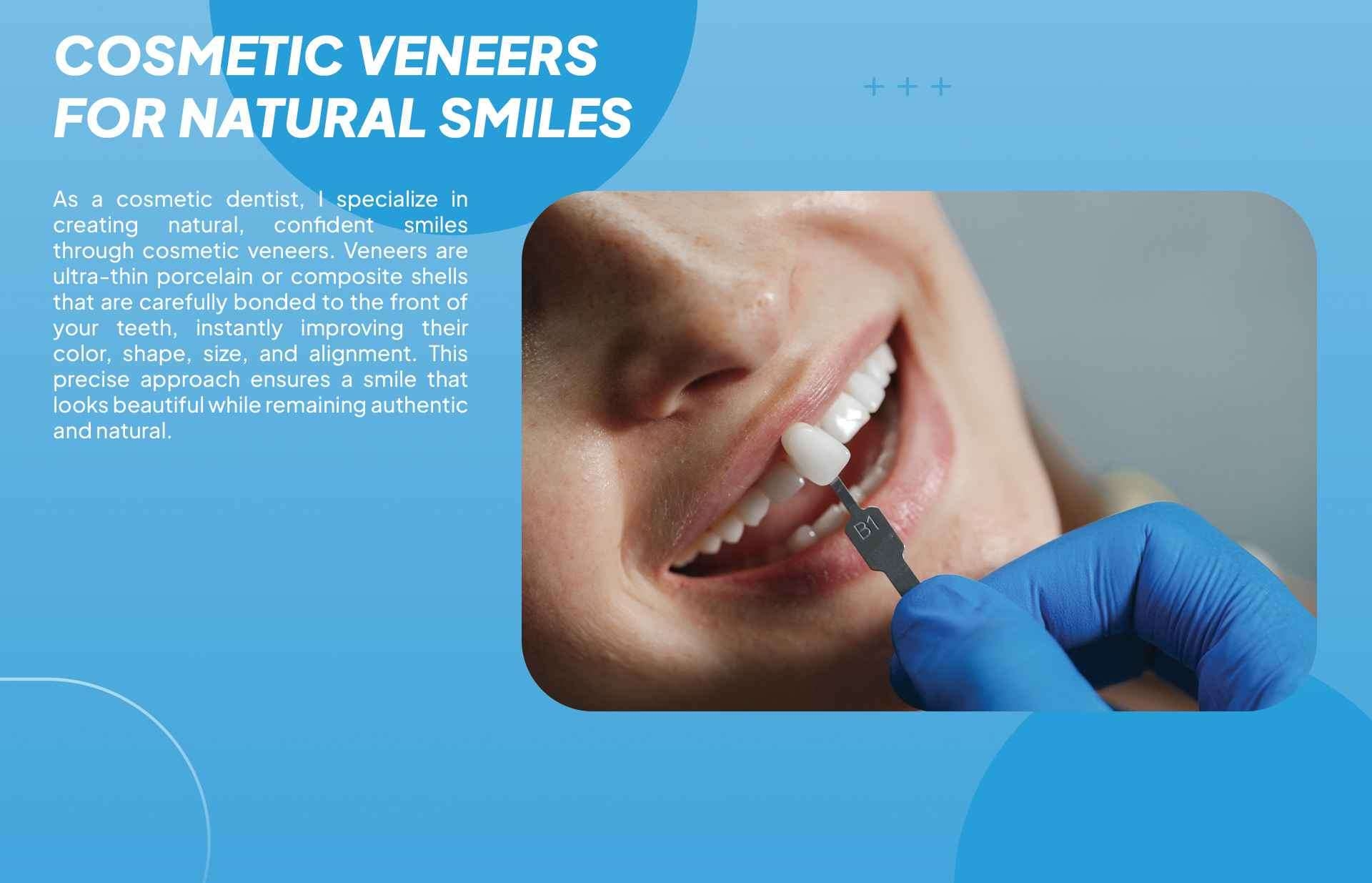 Cosmetic Veneers  2
