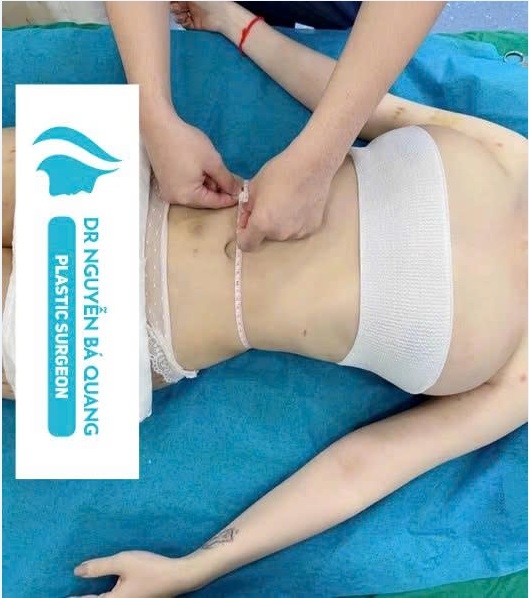 Hút mỡ bụng - Liposuction. 3
