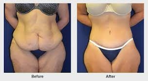 Weight Loss Surgery