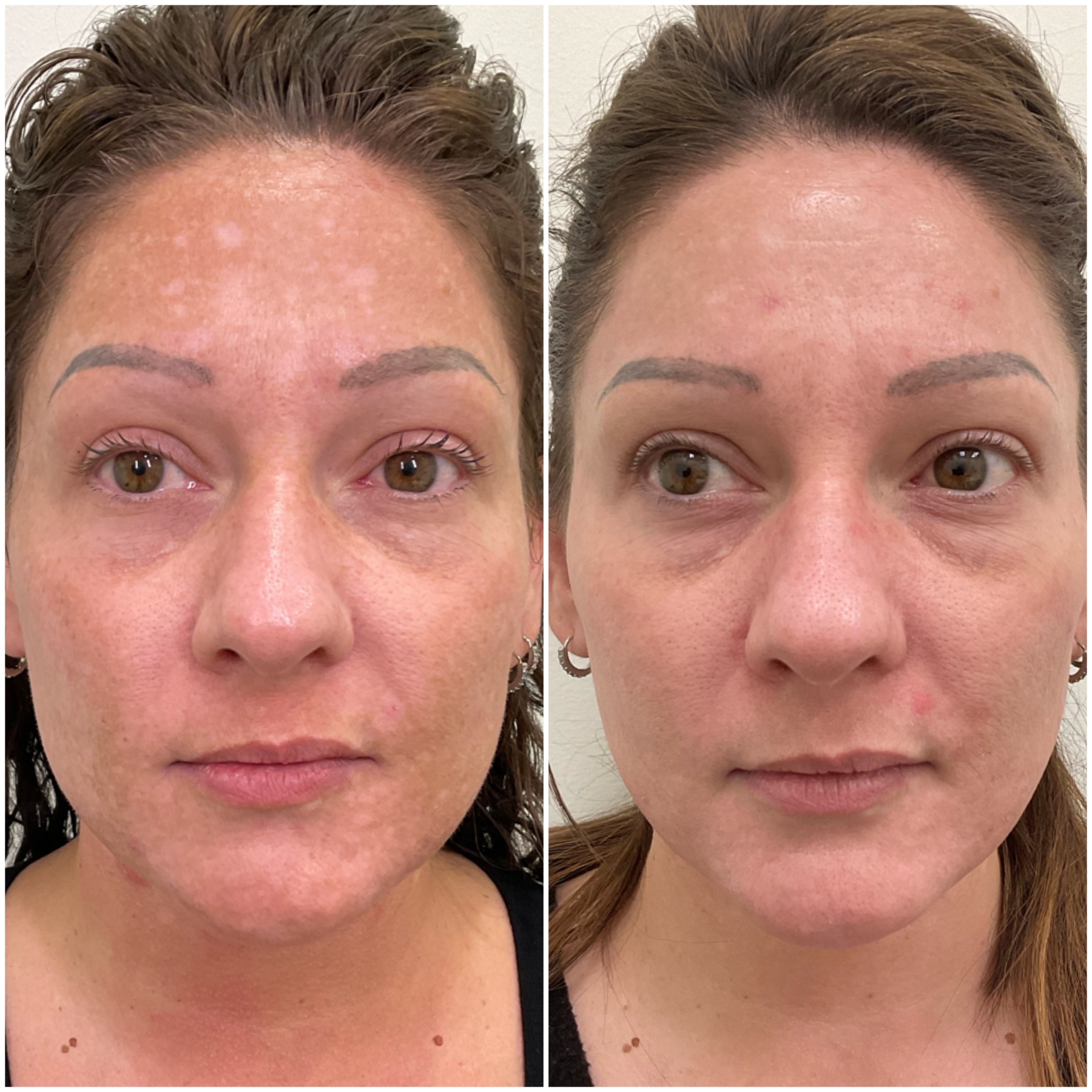 🌸 DEEP MELASMA TREATMENT SERVICE & PERSONALIZED CONSULTATION🌸 2