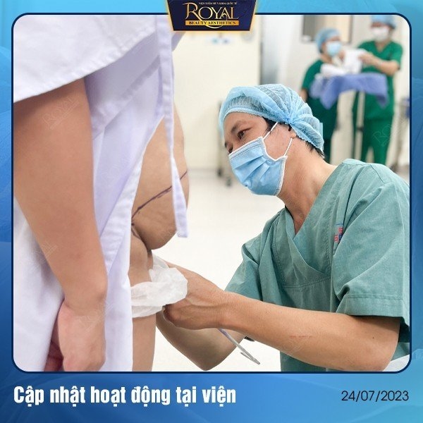 Hút mỡ bụng - Liposuction. 1