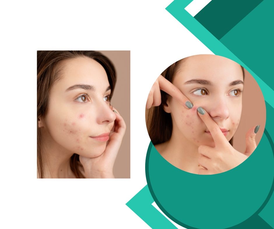 Clear Your Acne Naturally -Science based skincare and hormonal support by medical graduate 2