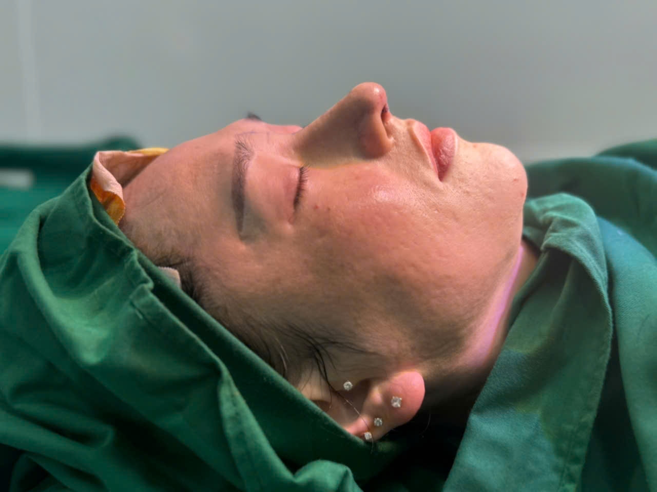 PHẪU THUẬT NÂNG MŨI (Nose surgery), Sửa Mũi, Mũi Cấu Trúc, Mũi Sụn Tai, Mũi Thường. 2