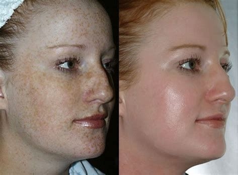 🌸DEEP MELASMA CONSULTATION - PERSONALIZED REGIMEN FOR BRIGHT, HEALTHY SKIN🌸 2