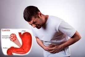 Alivio Eficaz para la Gastritis y Úlceras