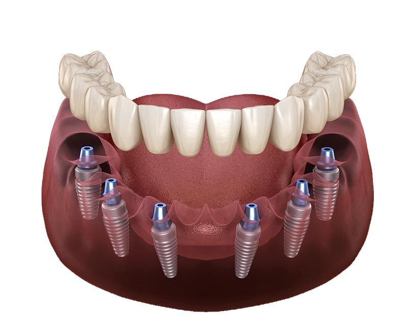 Offline Implant Surgery