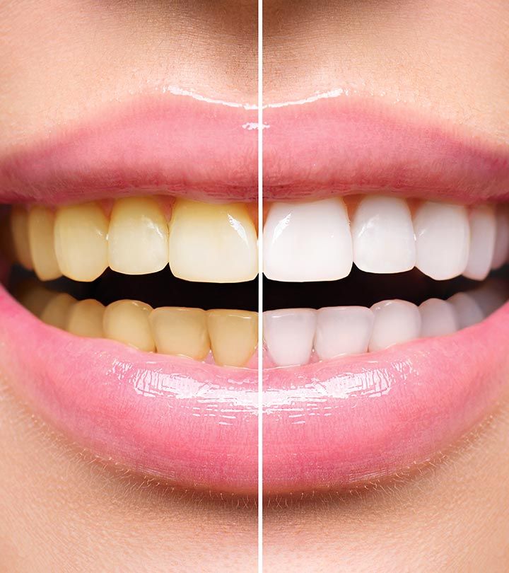 Teeth Whitening 4