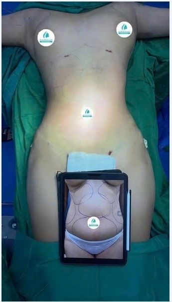 Abdominal Liposuction - Hút Mỡ Bụng 4