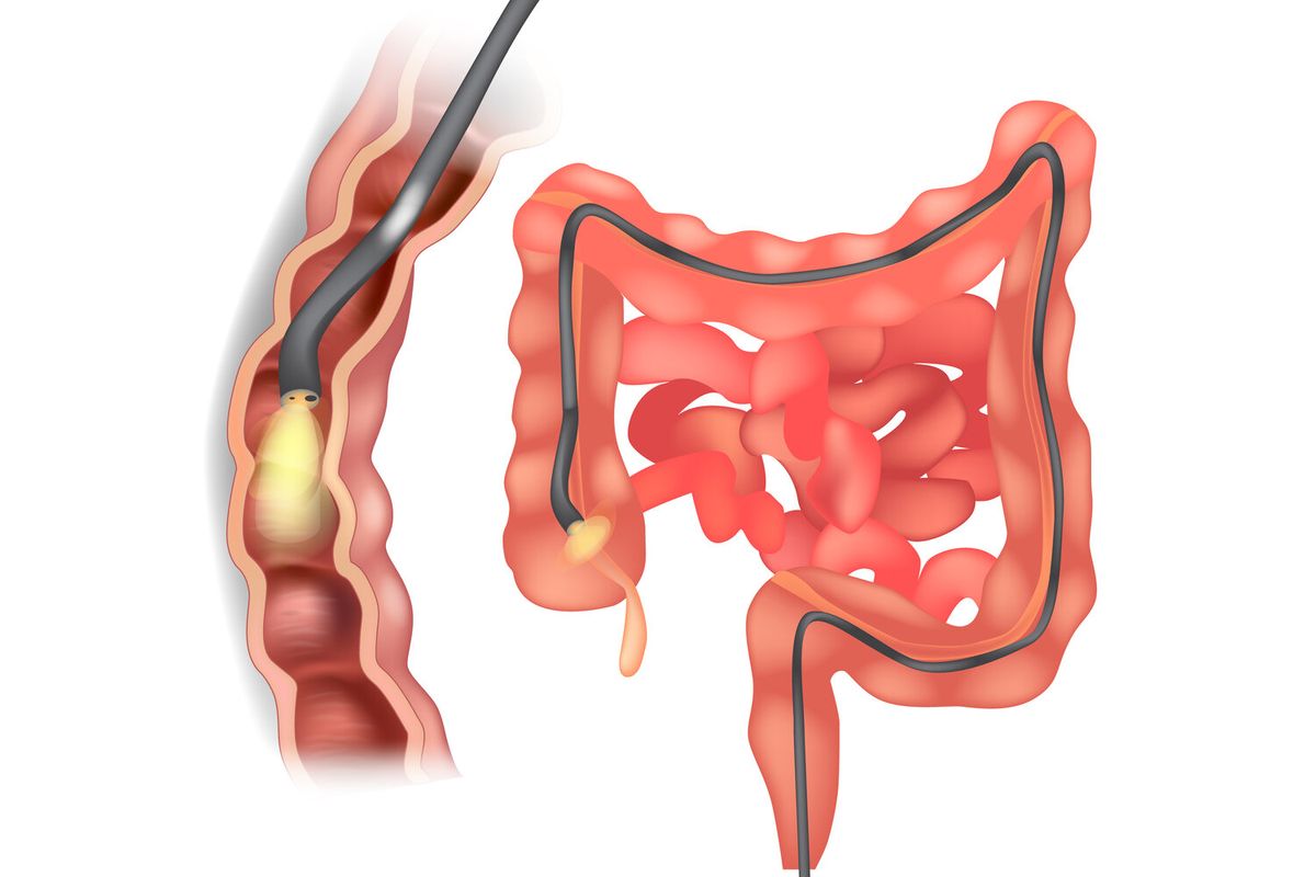 Advanced Gastrointestinal Endoscopy (Endoscopy & Colonoscopy Package) 3