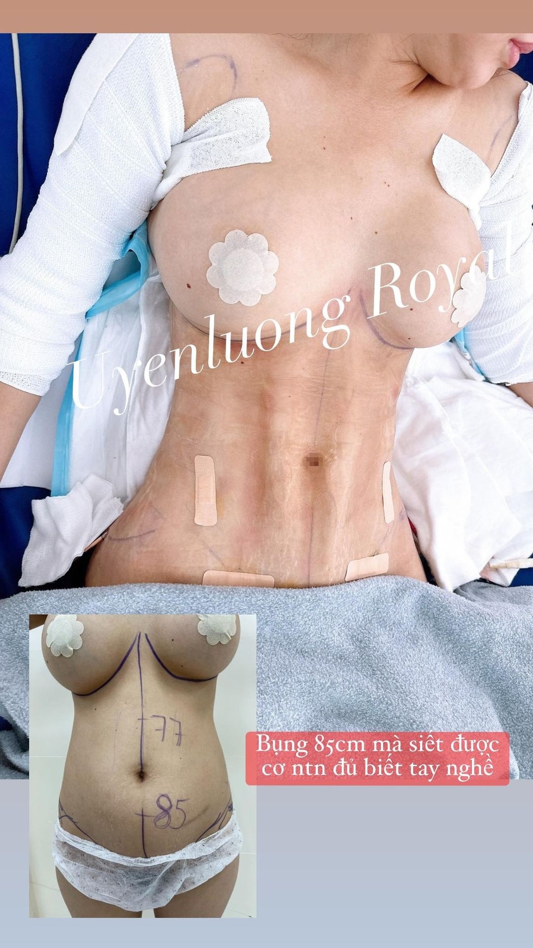 Liposuction, Abdominal Plasty, Abdominal Skin Removal, Tạo hình thành bụng, cắt da bụng, căng da bụng, hút mỡ bụng. 2