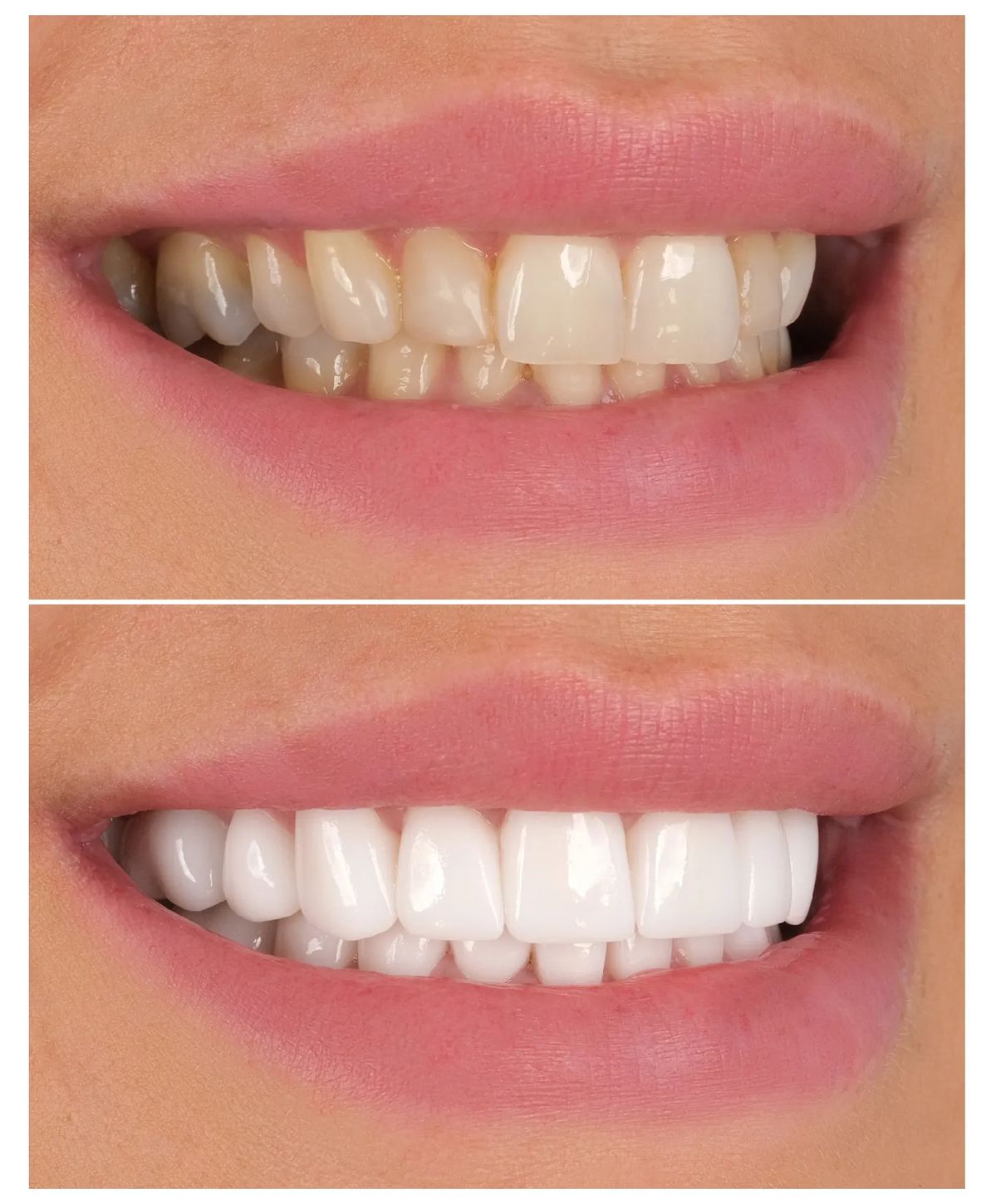 Teeth Whitening
