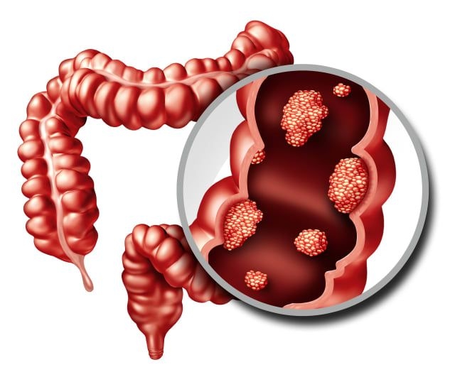 Consultation Service for Chronic Inflammatory Bowel Disease (IBD – Crohn’s & Ulcerative Colitis)