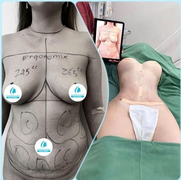 Abdominal Liposuction - Hút Mỡ Bụng 2