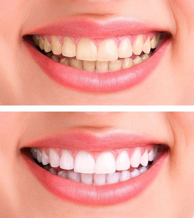 Teeth Whitening 2