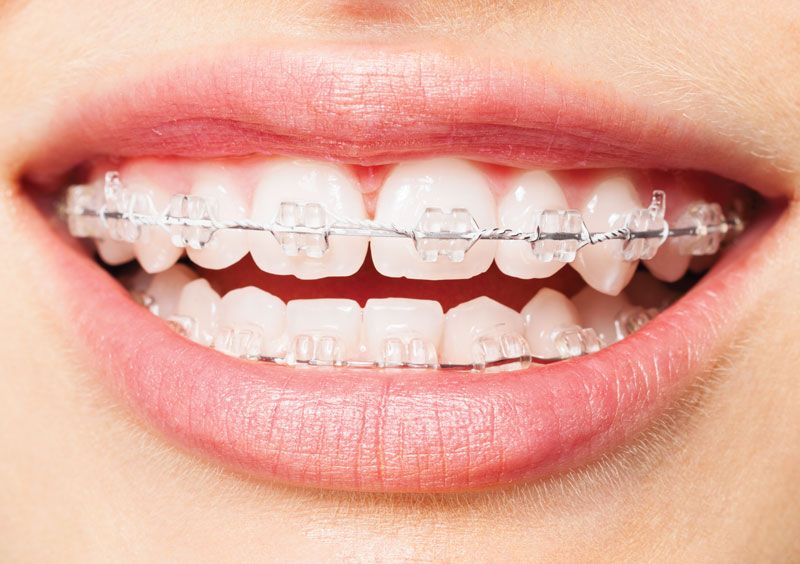 Clear braces