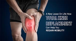 Total Knee Replacement  2