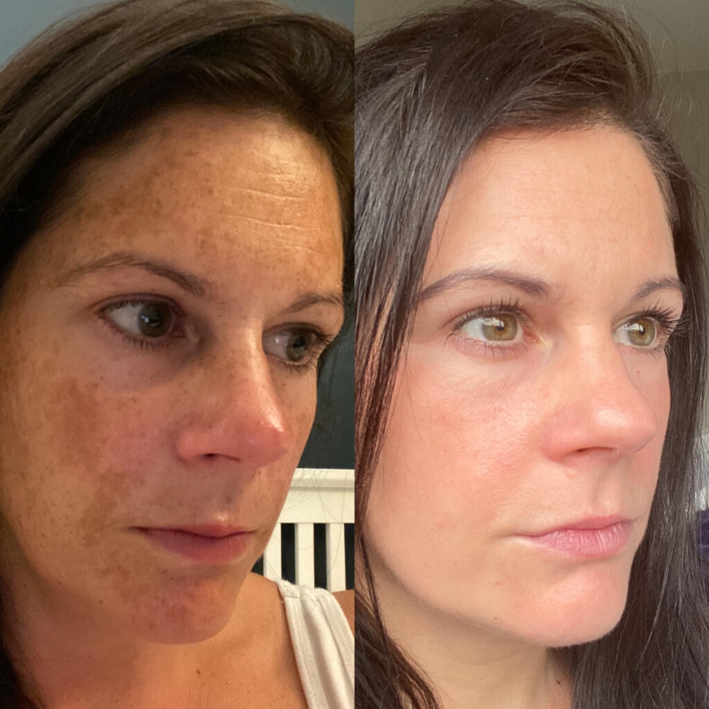 🌸 DEEP MELASMA TREATMENT SERVICE & PERSONALIZED CONSULTATION🌸 3