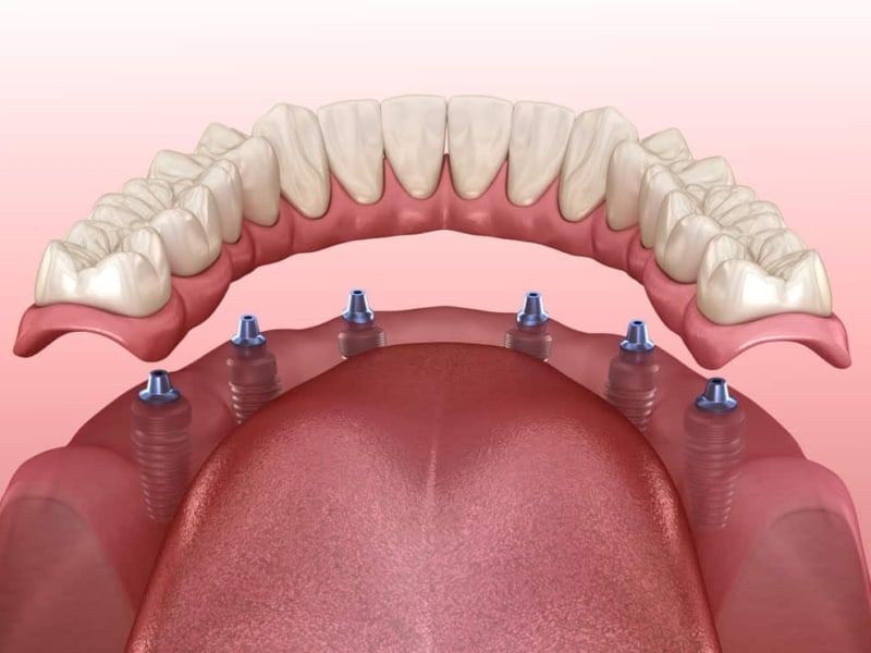 Offline Implant Surgery 2