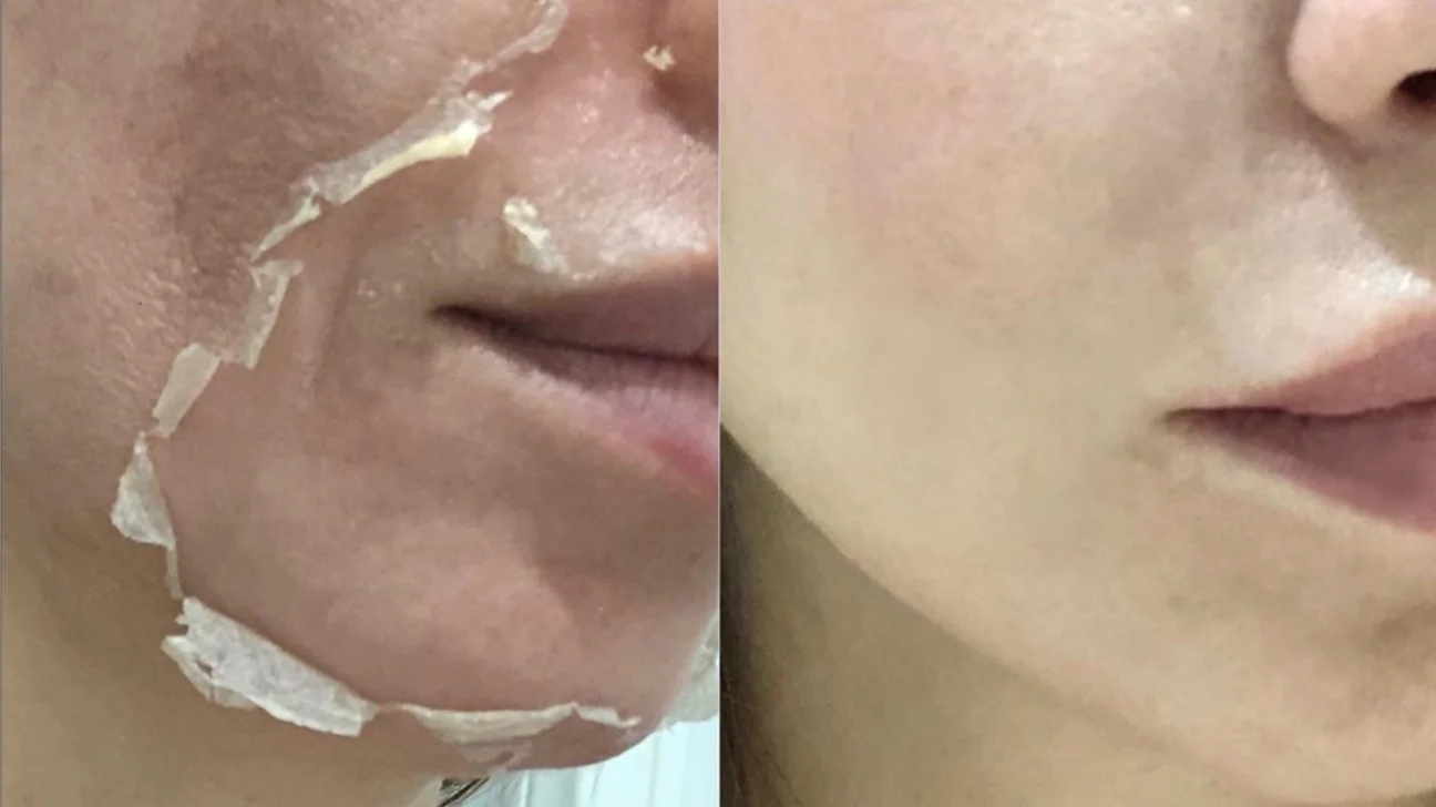 🌸 DEEP MELASMA TREATMENT SERVICE & PERSONALIZED CONSULTATION🌸