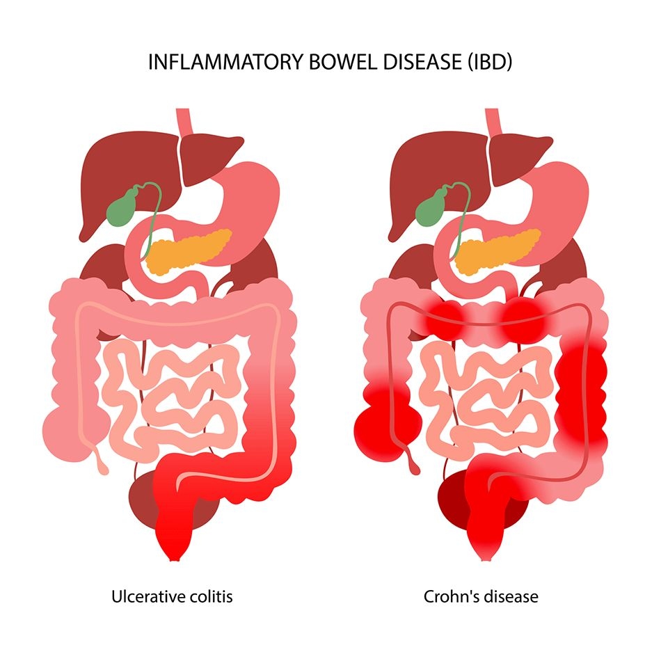 Consultation Service for Chronic Inflammatory Bowel Disease (IBD – Crohn’s & Ulcerative Colitis) 2