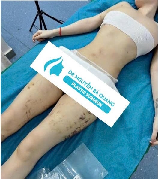 Hút mỡ bụng - Liposuction. 5