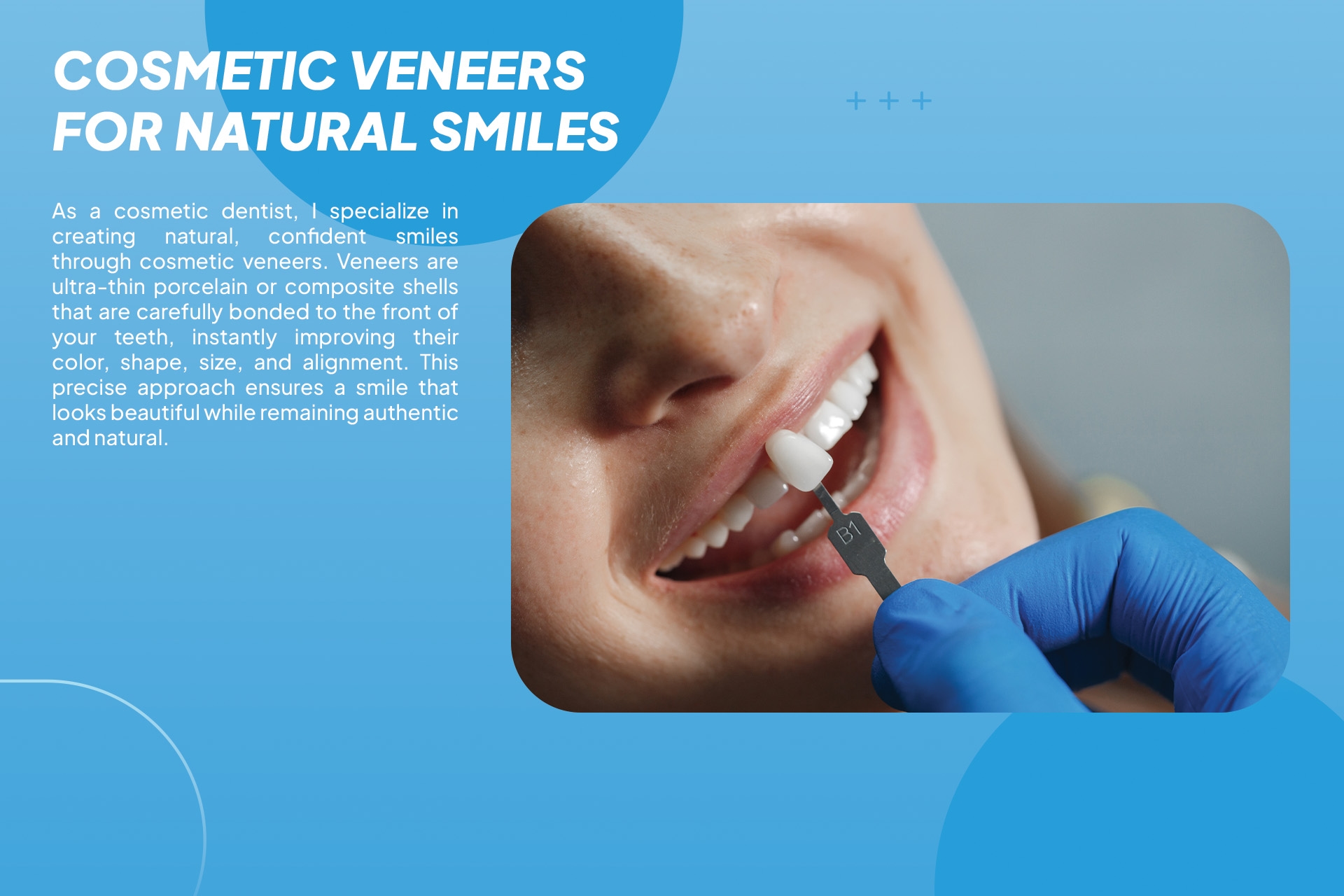 Cosmetic Veneers  4