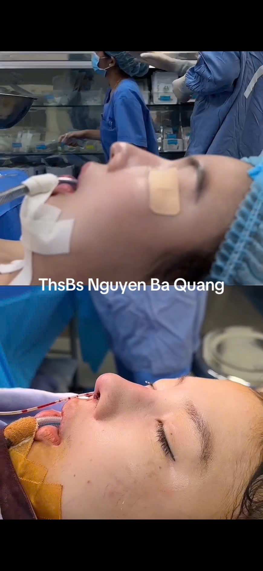 Rhinoplasty, Nose Job, Nose Augmentation; nâng mũi, mũi cấu trúc, phẫu thuật nâng mũi, sửa mũi. 2
