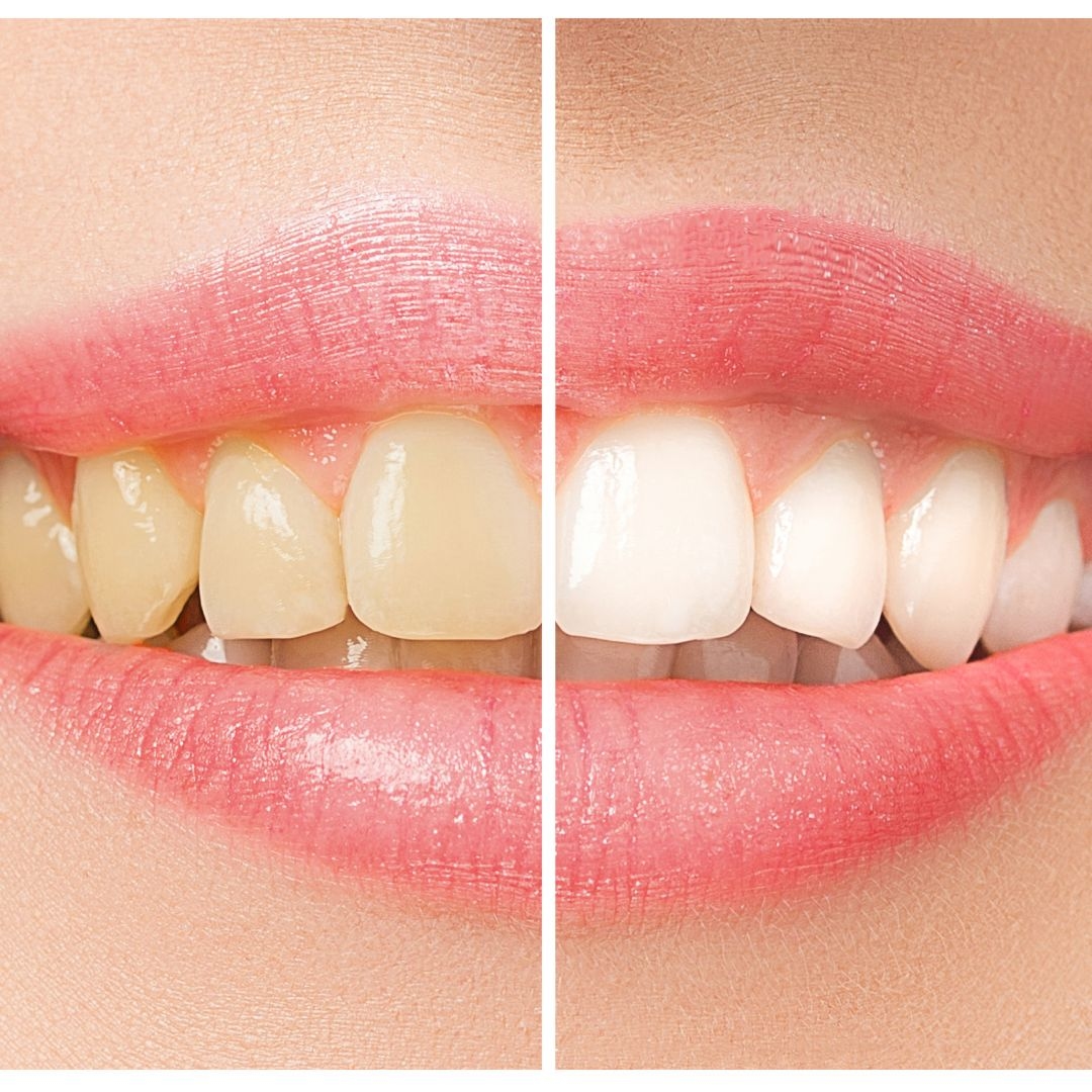 Safe teeth whitening – Fast results