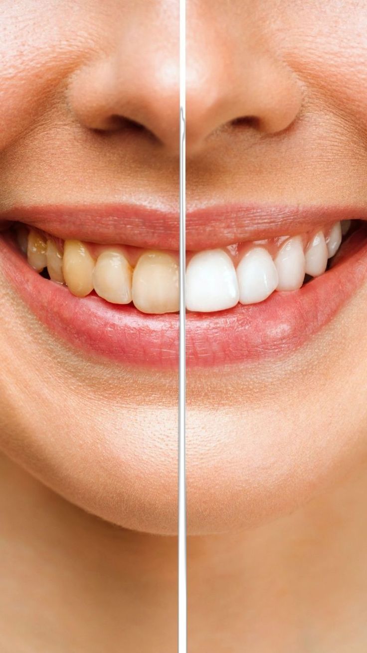 Teeth Whitening 3