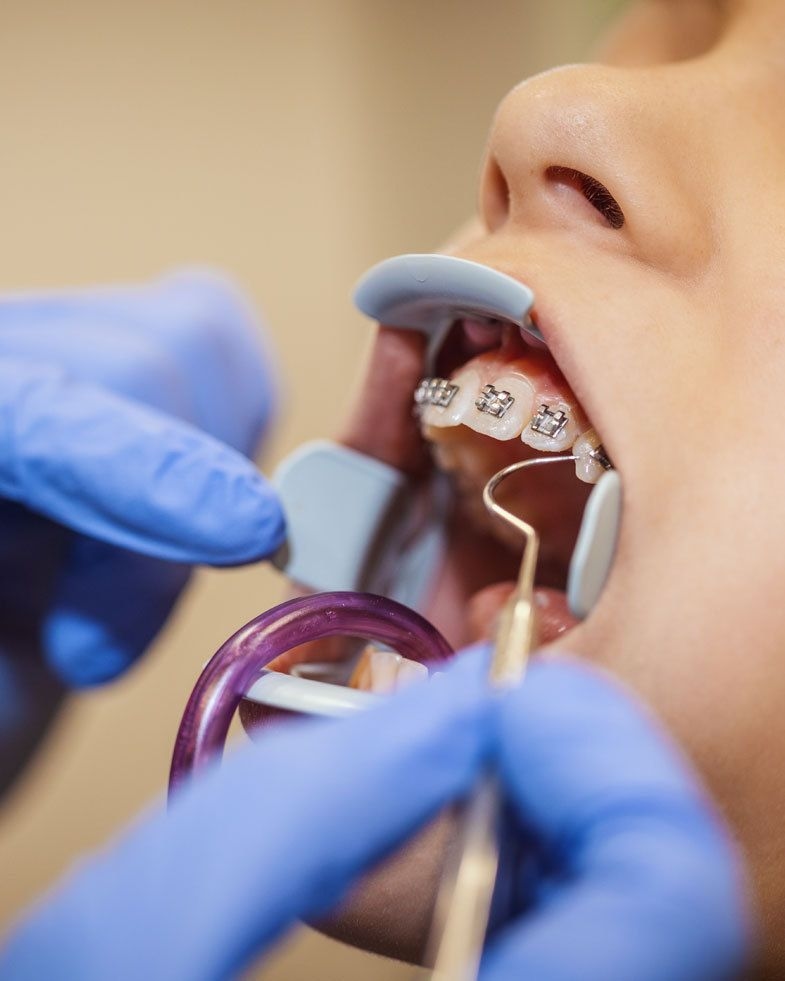 Cavity treatment and cosmetic restoration 3
