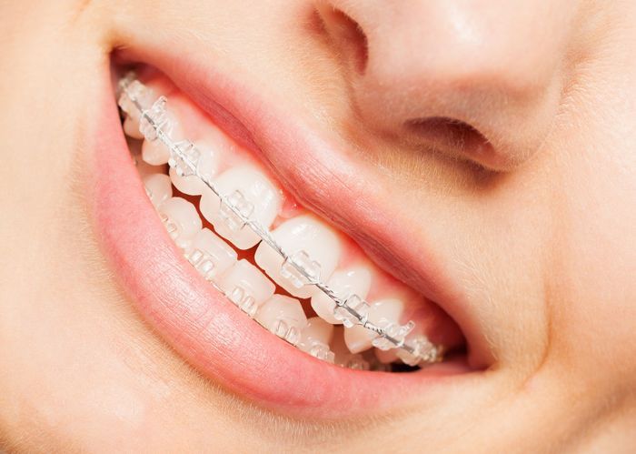 Clear braces 2