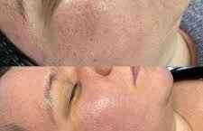 Offline Acne Scar Laser Treatment 2