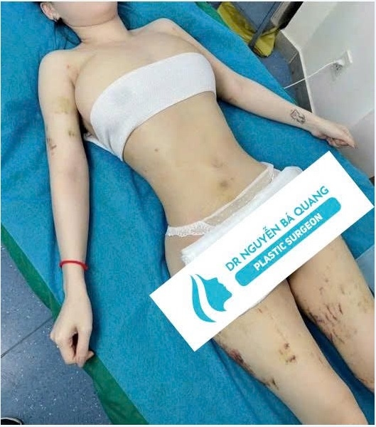 Hút mỡ bụng - Liposuction. 4