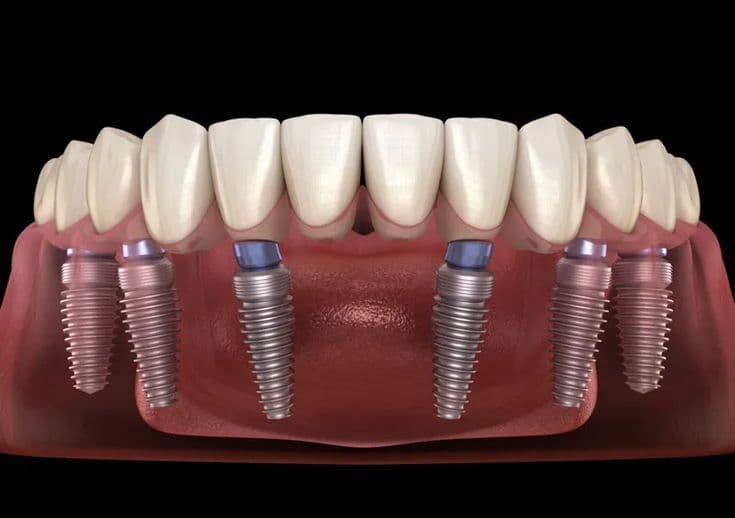 Dental Implants – A Modern Solution for Missing Teeth