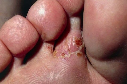 Blisters by Athlete's Foot: What Is It, and How to Book a Consultation Service for Its Treatment Through StrongBody AI