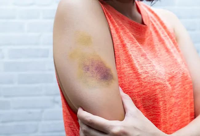Understanding Bleeding and Bruising: A Symptom Not to Overlook