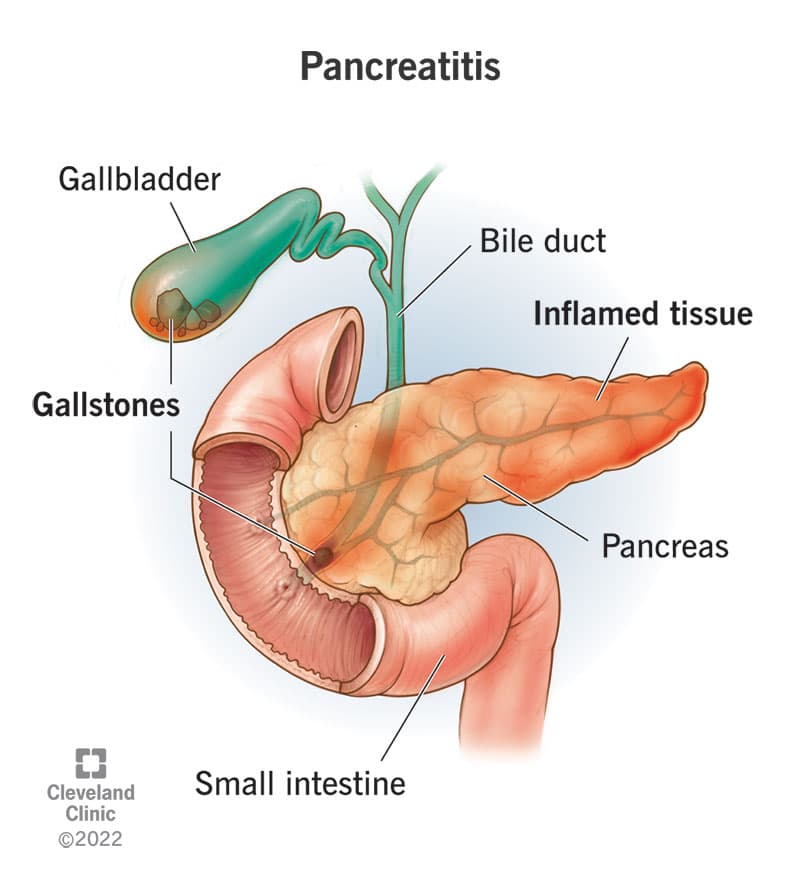 Loss of Appetite by Acute Pancreatitis: What it is, and How to Book a Consultation Service for Its Treatment Through StrongBody AI