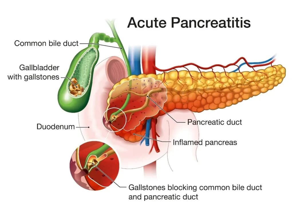 Jaundice by Acute Pancreatitis: What it is, and How to Book a Consultation Service for Its Treatment Through StrongBody AI