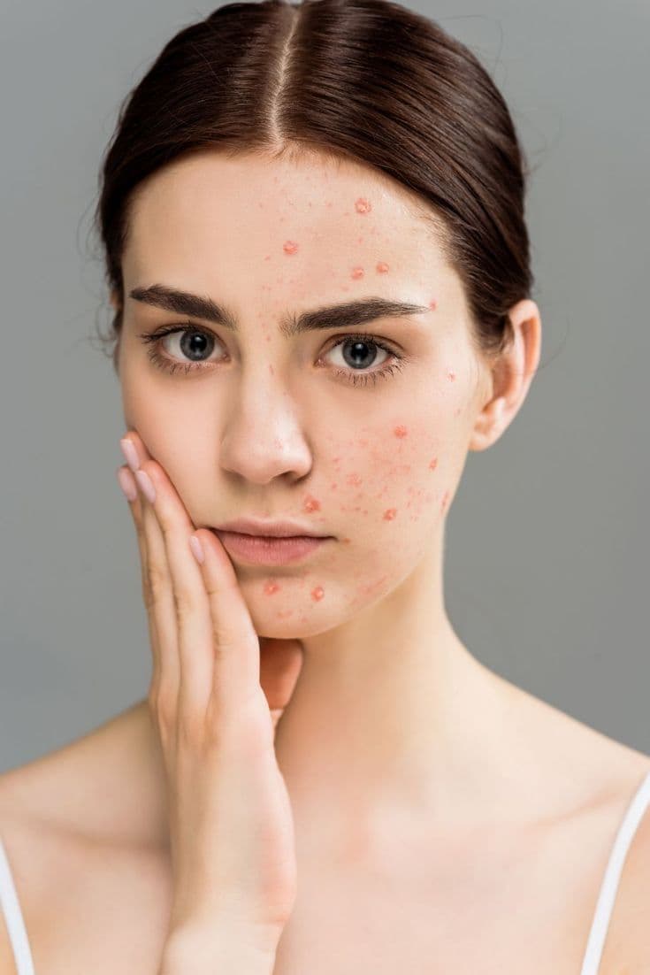 Understanding and Coping with Psoriasis – The Journey to Skin 