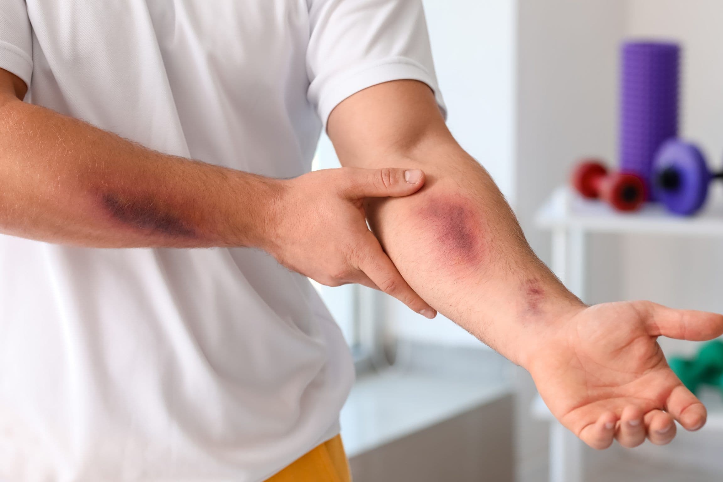 Easy Bleeding – A Warning Sign of Aplastic Anemia and How to Book a Consultation via StrongBody AI