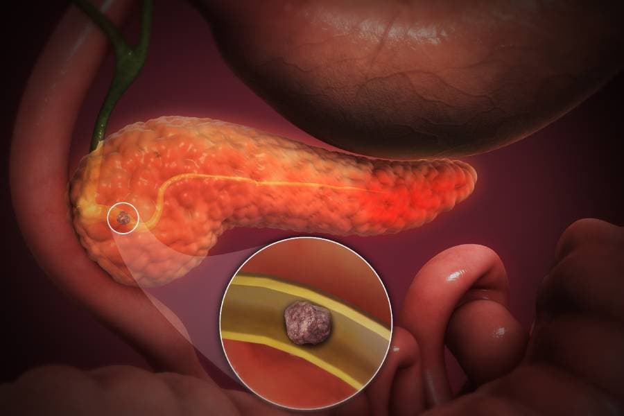 Tachycardia by Acute Pancreatitis: What it is, and How to Book a Consultation Service for Its Treatment Through StrongBody AI