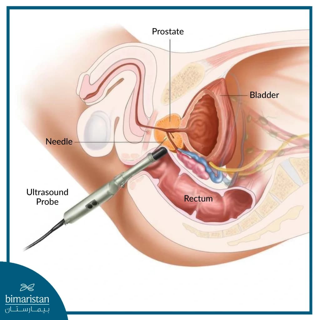 Difficulty Urinating by Acute Prostatitis: What it is, and How to Book a Consultation Service for Its Treatment Through StrongBody AI