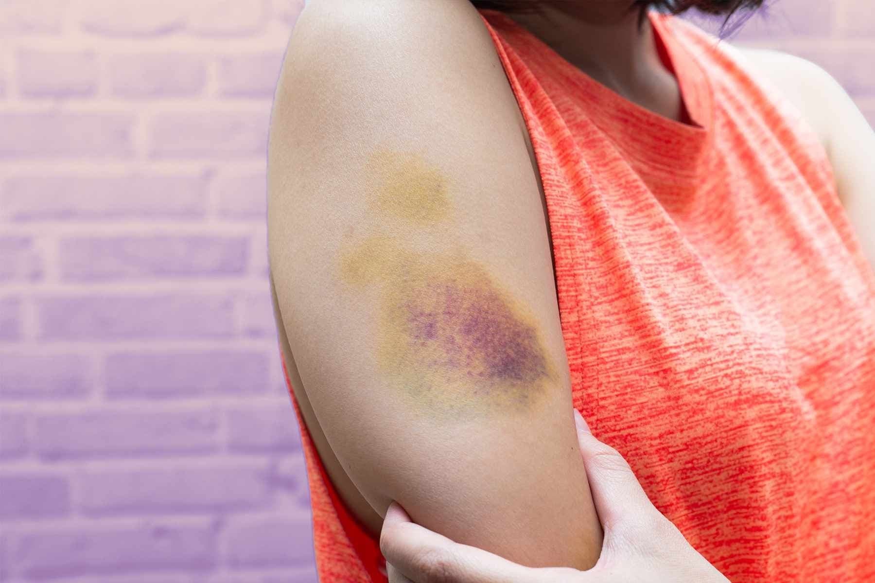 Easy Bruising or Prolonged Bleeding: What It Is and How to Book a Consultation Service for Its Treatment ThrStrongBodyAI