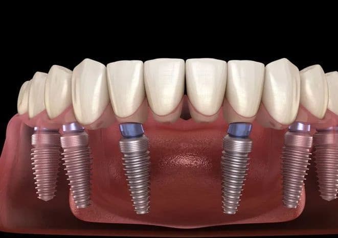 Dental Implants – A Modern Solution for Missing Teeth